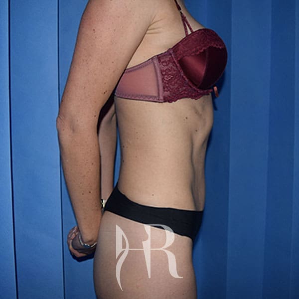 HR Plastic Surgery - Mini Tummy Tuck patient after 3